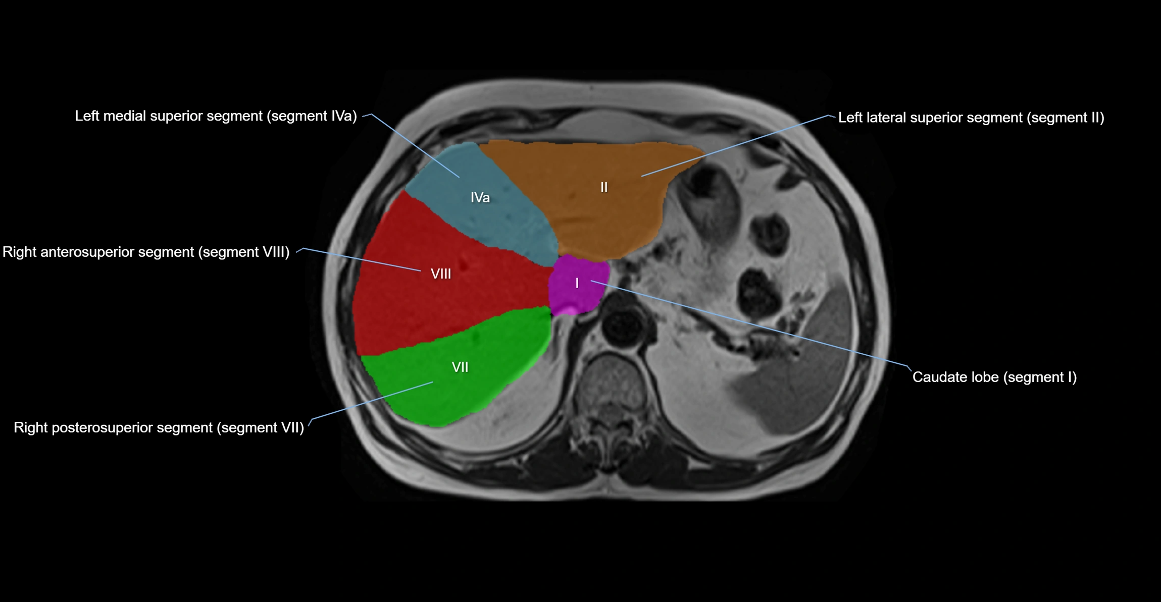 MRI  liver segments anatomy axial cross sectional 3T radiology  image-img-00001-00012.webp